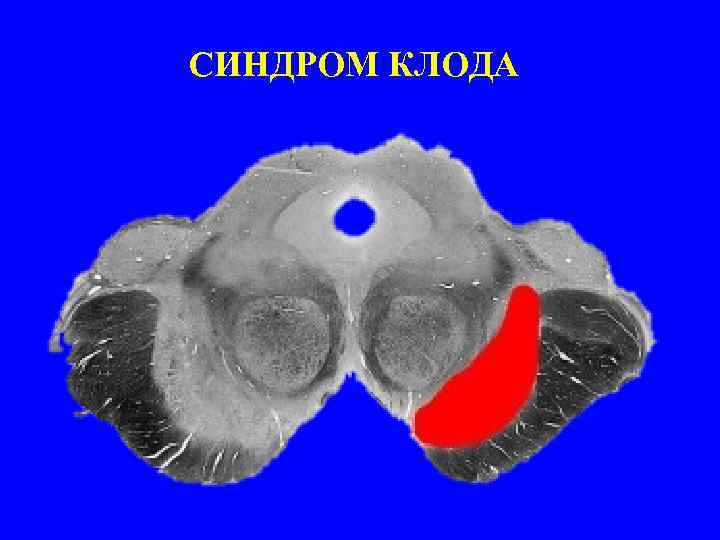 СИНДРОМ КЛОДА 