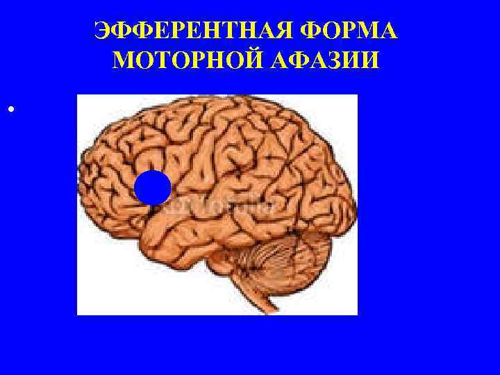 ЭФФЕРЕНТНАЯ ФОРМА МОТОРНОЙ АФАЗИИ • 