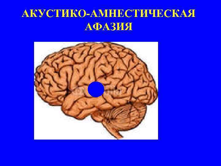 АКУСТИКО-АМНЕСТИЧЕСКАЯ АФАЗИЯ 