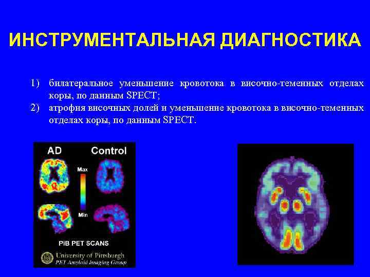ИНСТРУМЕНТАЛЬНАЯ ДИАГНОСТИКА 1) билатеральное уменьшение кровотока в височно-теменных отделах коры, по данным SPECT; 2)