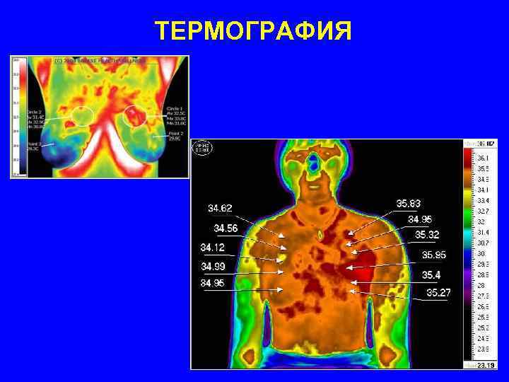 ТЕРМОГРАФИЯ 