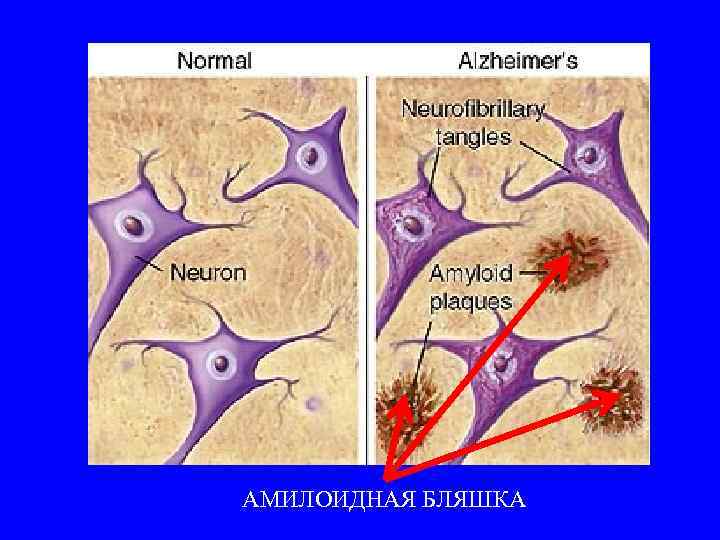 АМИЛОИДНАЯ БЛЯШКА 