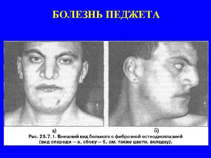 БОЛЕЗНЬ ПЕДЖЕТА 