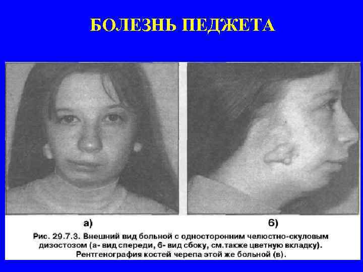 БОЛЕЗНЬ ПЕДЖЕТА 