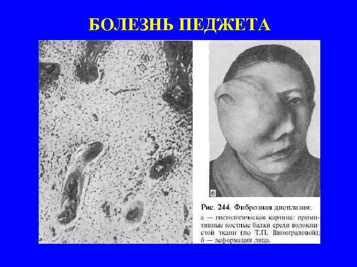 БОЛЕЗНЬ ПЕДЖЕТА 