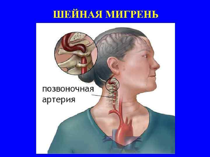 ШЕЙНАЯ МИГРЕНЬ 