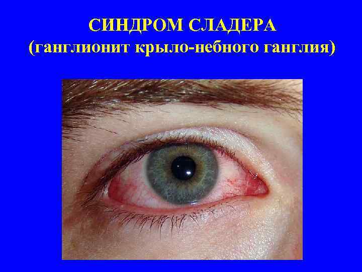 СИНДРОМ СЛАДЕРА (ганглионит крыло-небного ганглия) 
