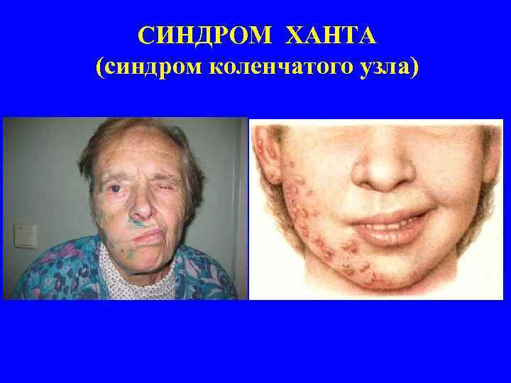 СИНДРОМ ХАНТА (синдром коленчатого узла) 