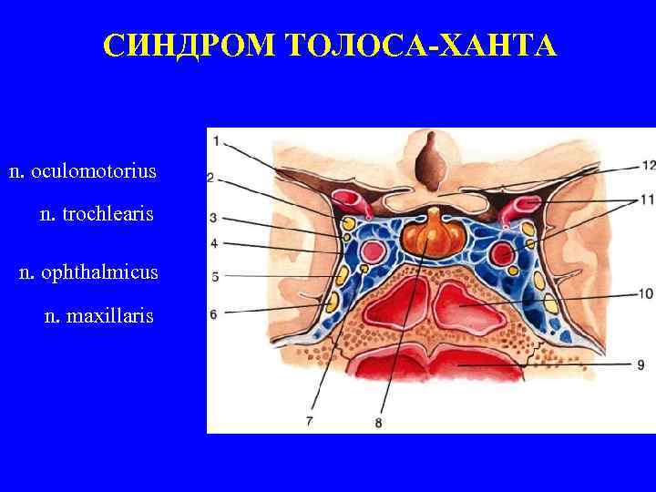 СИНДРОМ ТОЛОСА-ХАНТА n. oculomotorius n. trochlearis n. ophthalmicus n. maxillaris 
