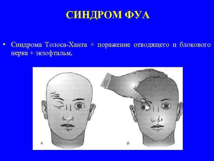 СИНДРОМ ФУА • Синдрома Толоса-Ханта + поражение отводящего и блокового нерва + экзофтальм. 