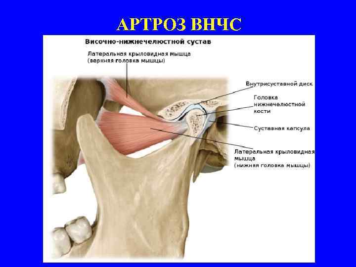 АРТРОЗ ВНЧС 