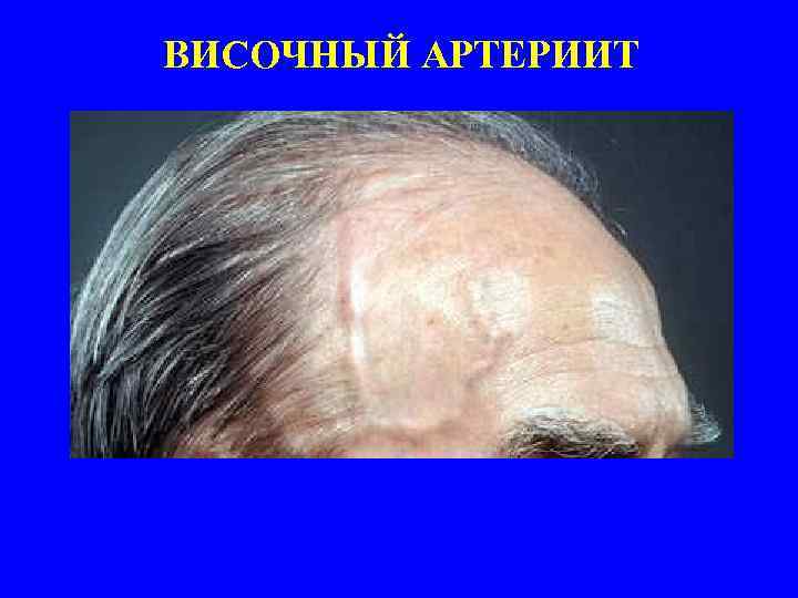 ВИСОЧНЫЙ АРТЕРИИТ 