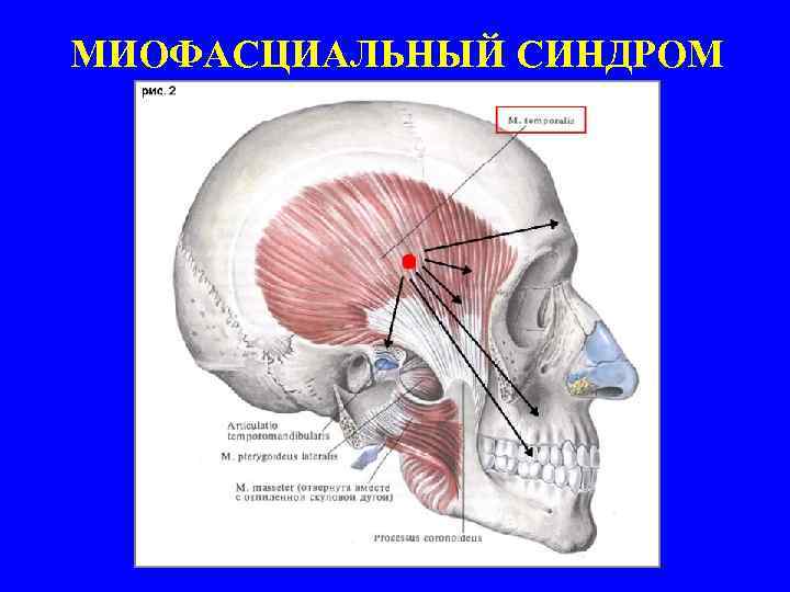 МИОФАСЦИАЛЬНЫЙ СИНДРОМ 