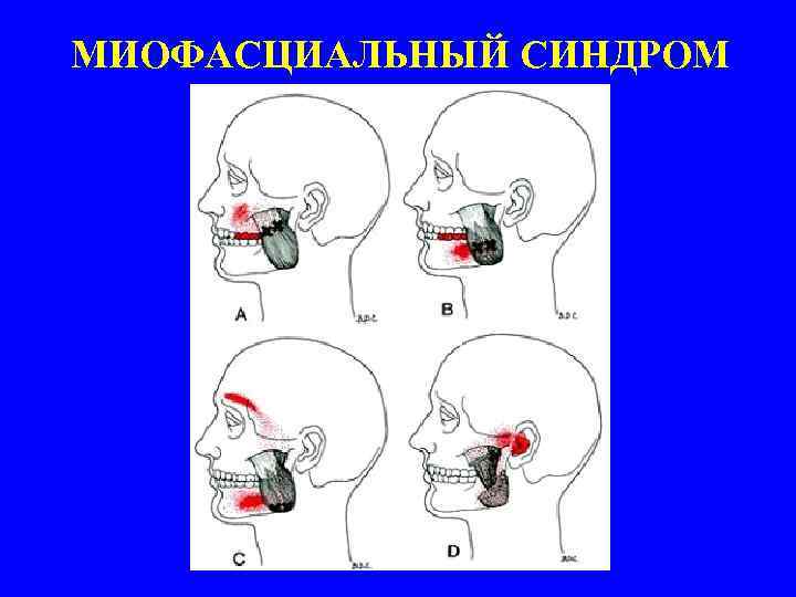 Лицевые боли неврология презентация