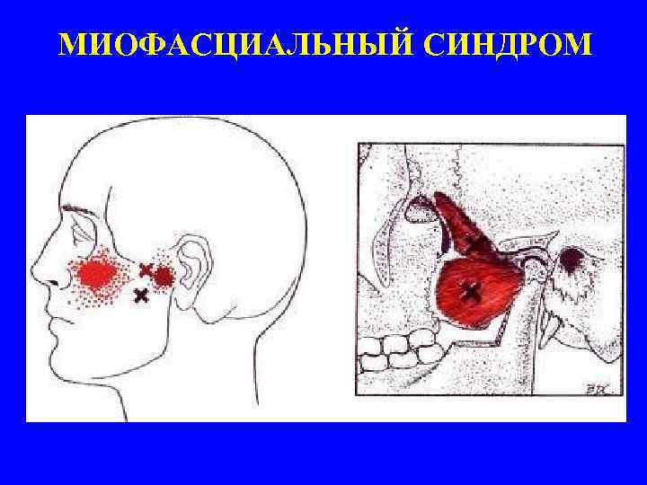 Синдром моторной дисфазии