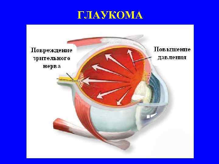 ГЛАУКОМА 