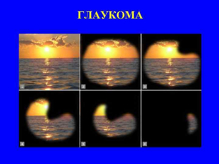 Как видит человек с глаукомой картинки