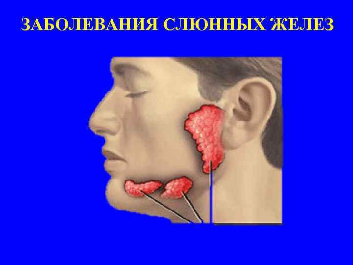 ЗАБОЛЕВАНИЯ СЛЮННЫХ ЖЕЛЕЗ 