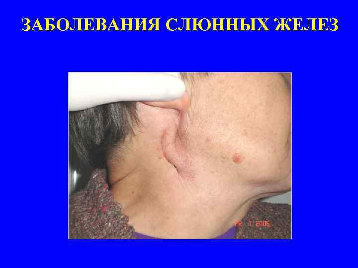 ЗАБОЛЕВАНИЯ СЛЮННЫХ ЖЕЛЕЗ 