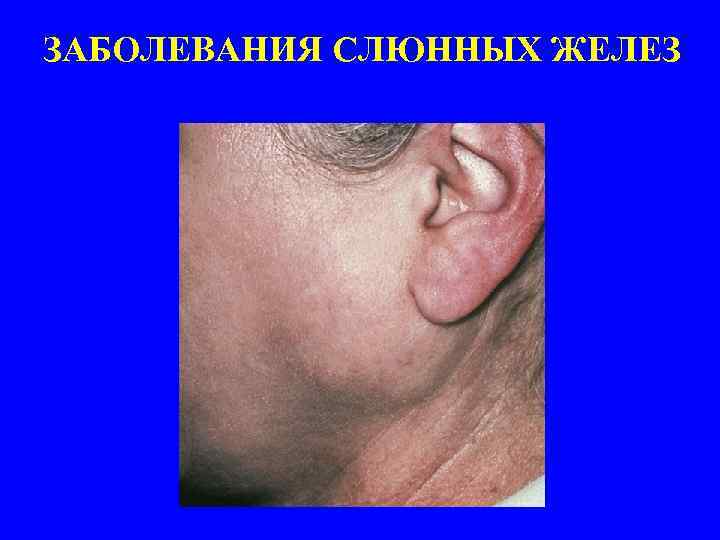 ЗАБОЛЕВАНИЯ СЛЮННЫХ ЖЕЛЕЗ 