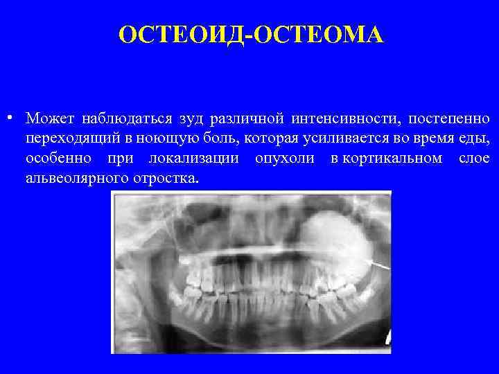 ОСТЕОИД-ОСТЕОМА • Может наблюдаться зуд различной интенсивности, постепенно переходящий в ноющую боль, которая усиливается