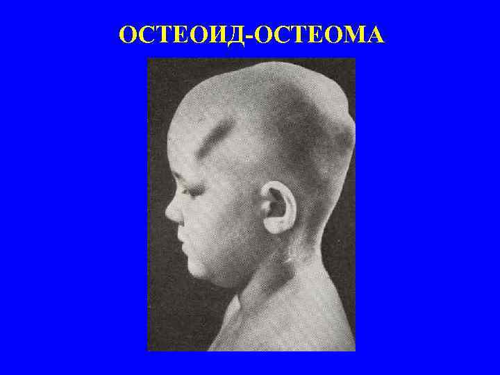 ОСТЕОИД-ОСТЕОМА 
