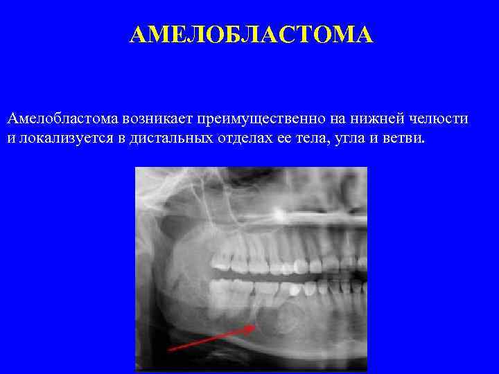 Клиническая картина амелобластомы