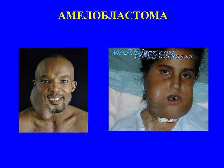 АМЕЛОБЛАСТОМА 