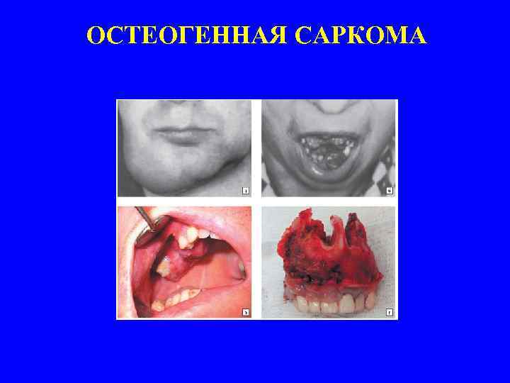 ОСТЕОГЕННАЯ САРКОМА 
