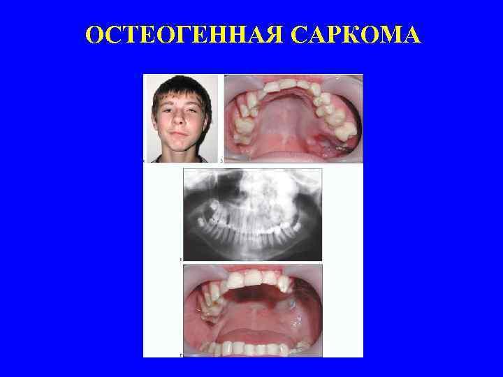 ОСТЕОГЕННАЯ САРКОМА 