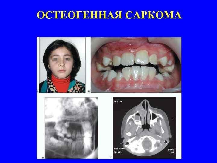 ОСТЕОГЕННАЯ САРКОМА 