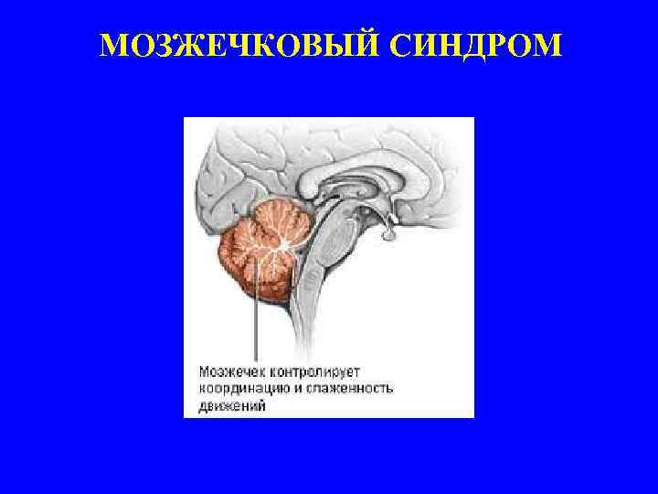 МОЗЖЕЧКОВЫЙ СИНДРОМ 
