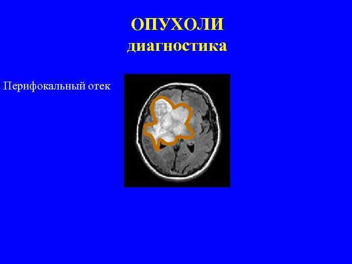 ОПУХОЛИ диагностика Перифокальный отек 