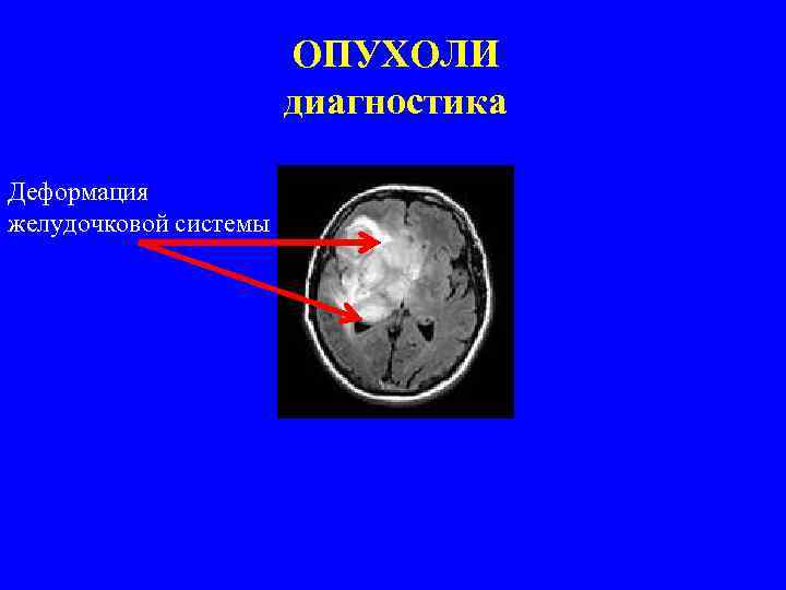 ОПУХОЛИ диагностика Деформация желудочковой системы 