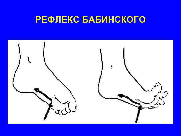 РЕФЛЕКС БАБИНСКОГО 