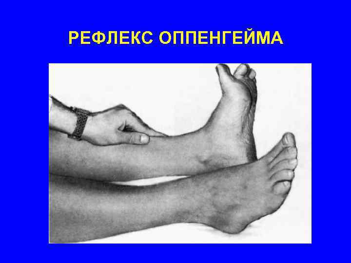 РЕФЛЕКС ОППЕНГЕЙМА 