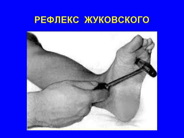 РЕФЛЕКС ЖУКОВСКОГО 