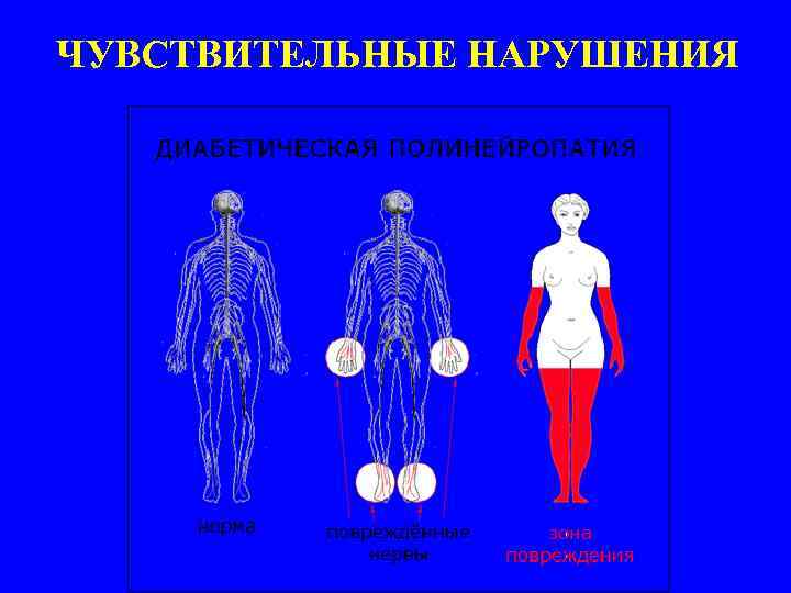 ЧУВСТВИТЕЛЬНЫЕ НАРУШЕНИЯ 