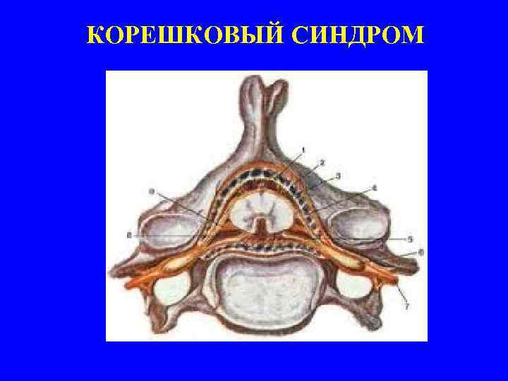 Радикулопатия карта вызова