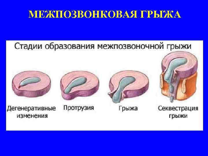 МЕЖПОЗВОНКОВАЯ ГРЫЖА 