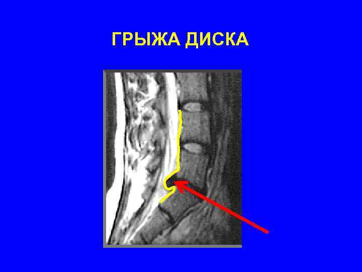 ГРЫЖА ДИСКА 