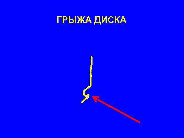 ГРЫЖА ДИСКА 