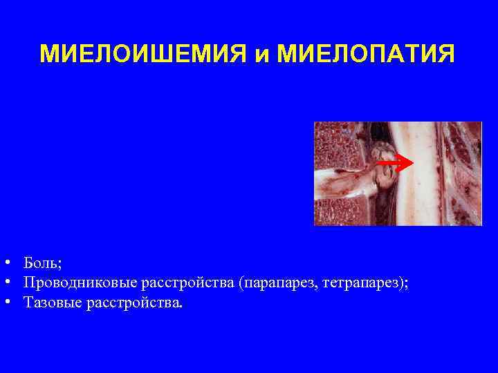 МИЕЛОИШЕМИЯ и МИЕЛОПАТИЯ • Боль; • Проводниковые расстройства (парапарез, тетрапарез); • Тазовые расстройства. 