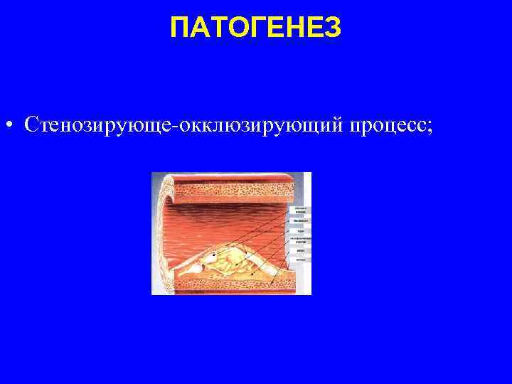 ПАТОГЕНЕЗ • Стенозирующе-окклюзирующий процесс; 