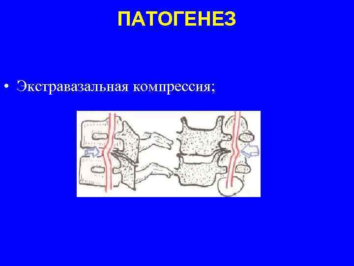 ПАТОГЕНЕЗ • Экстравазальная компрессия; 