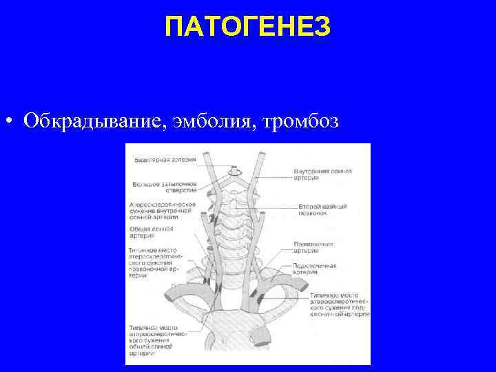 ПАТОГЕНЕЗ • Обкрадывание, эмболия, тромбоз 
