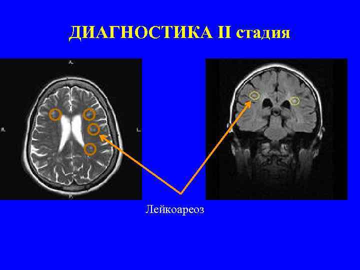 ДИАГНОСТИКА II стадия Лейкоареоз 