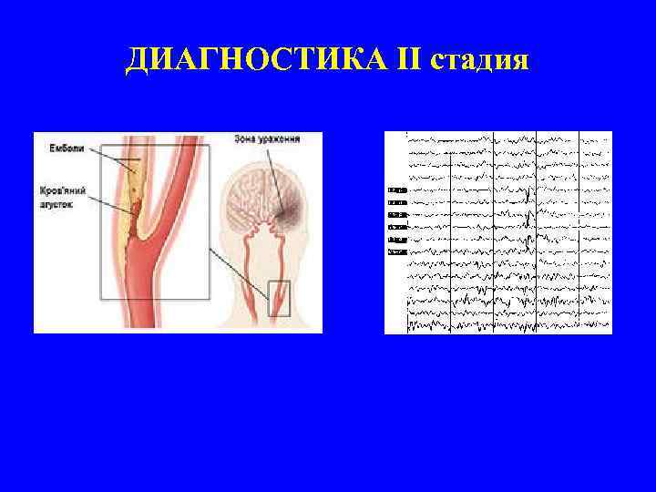 ДИАГНОСТИКА II стадия 