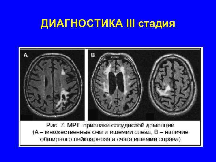 ДИАГНОСТИКА III стадия 