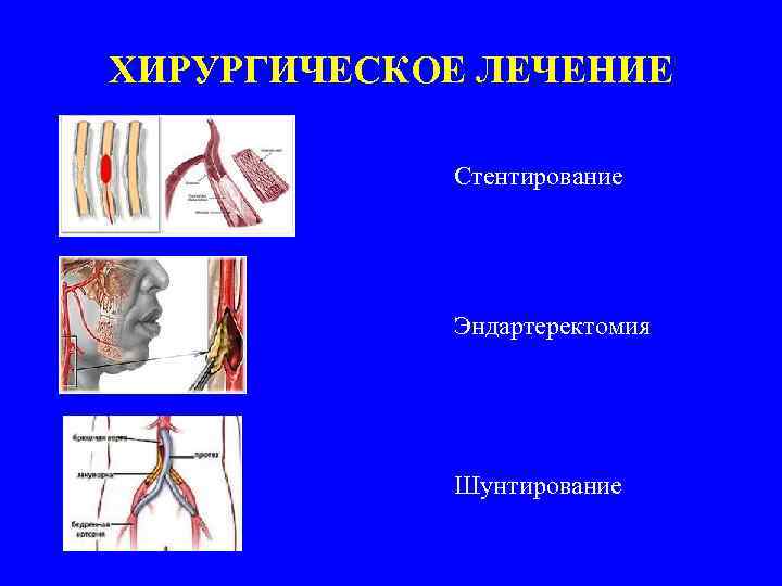 ХИРУРГИЧЕСКОЕ ЛЕЧЕНИЕ Стентирование Эндартеректомия Шунтирование 